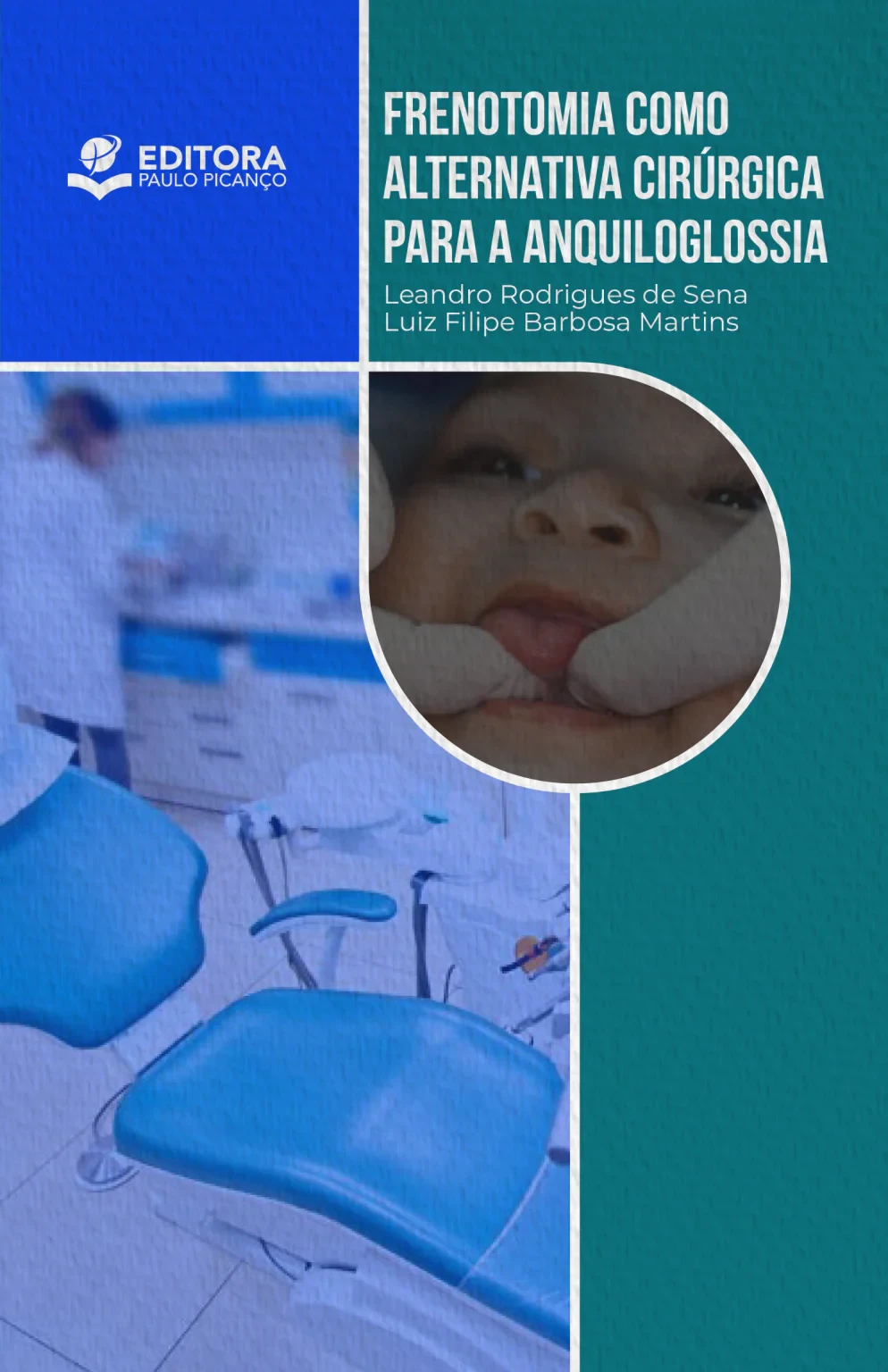 Frenotomia como Alternativa Cirúrgica para a Anquiloglossia