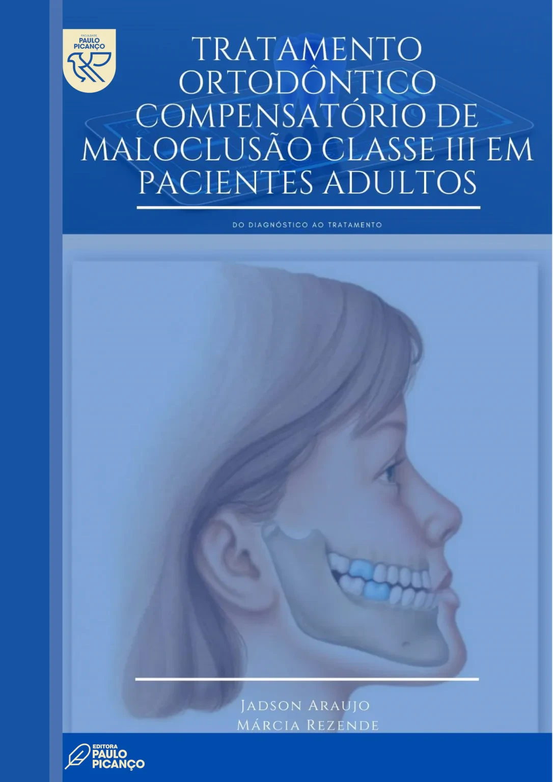Tratamento Ortodôntico compensatório de Maloclusão classe iii em pacientes adultos